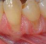 Fig 3. Clinical case highlighting the use of tunneling technique in the posterior mandibular arch with a soft-tissue alternative, ie, acellular dermal matrix, considering the limited amount of keratinized tissue present and the frenum attachment. Pretreatment.