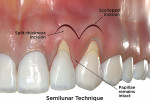 Fig 5. Comparative illustrations of minimally invasive CAF surgical techniques for the correction of gingival recession defects based on review of original articles describing the techniques. Semilunar technique is shown. (red dotted line = sulcular incision; green dotted line = coronally advanced flap) (Illustrations by BroadcastMed LLC based on original concept art by Jessica M. Latimer, DDS.)