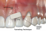 Fig 5. Comparative illustrations of minimally invasive CAF surgical techniques for the correction of gingival recession defects based on review of original articles describing the techniques. Tunneling technique is shown. (blue dotted line = internal bevel incision) (CTG = connective tissue graft) (Illustrations by BroadcastMed LLC based on original concept art by Jessica M. Latimer, DDS.)