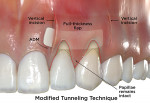 Fig 5. Comparative illustrations of minimally invasive CAF surgical techniques for the correction of gingival recession defects based on review of original articles describing the techniques. Modified tunneling technique is shown. (red dotted line = sulcular incision; green dotted line = coronally advanced flap) (ADM = acellular dermal matrix) (Illustrations by BroadcastMed LLC based on original concept art by Jessica M. Latimer, DDS.)