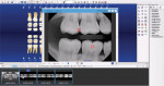 Dentrix Detect AI is an AI-powered x-ray analysis tool for the Dentrix Ascend Imaging system.