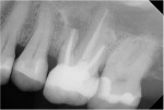 Preoperative radiograph of the previously restored maxillary left first molar, which was determined to be involved in a sinus perforation.