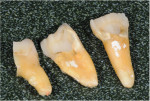 View of the sectioned molar following extraction.