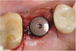 Postsurgical occlusal view of the tooth No. 14 site following placement of an implant and a stock healing abutment.