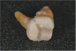 The extracted molar was reassembled into its original form with orthodontic wax.