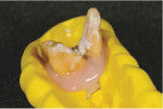 View of the molar placed into a matrix that was made prior to extraction. It was then lined with gingival masking material, which was trimmed to expose the contact area.