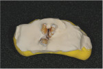 A cast was poured from dental stone, keeping the furcation clear.