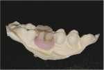 View of the cast with the reassembled tooth and gingival material.