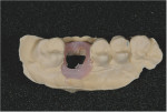 View of the cast after hot water was used to melt the wax and remove the molar fragments, showing the impression of the cervical area captured by the gingival masking material.
