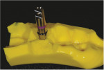 After the patient’s stock healing abutment was removed, an impression post was inserted into the implant, and an impression was made. Once set, an implant analog was attached to an impression post and inserted into the impression.