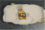 Top view of the space surrounding the implant analog.