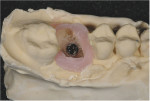 Occlusal view of the wax-surrounded implant analog embedded in the cast.