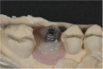 A temporary abutment was screwed into the implant and a bis-acryl composite resin was injected around it to fill the gap up to the gingival margin.