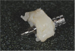 View of the custom healing abutment before trimming. Note how the resin flowed to the base of the abutment.