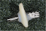 The custom healing abutment was trimmed, and the transition between the gingival margin and the base of the abutment was smoothed.