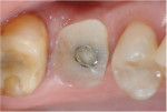 View of the custom healing abutment after a 5-month healing period.