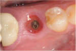Example of a healed implant site obtained with a stock healing abutment. Note the less-than-anatomic dimensions when compared with the site obtained by the custom healing abutment in Figure 21.