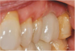 Posttreatment photograph of the definitive restoration 30 months after insertion demonstrating a natural emergence profile.