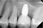 Posttreatment radiograph of the definitive restoration 30 months after insertion demonstrating preservation of the hard and soft tissues.