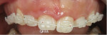 Retracted view of the initial maxillary orthodontic bandup on the day of insertion.
