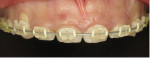 Retracted view of the final positions of the maxillary teeth after 12 months of orthodontic realignment and intrusion.