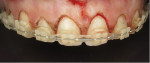 Electrosurgery was used to perform a gingivectomy to expose the full clinical crowns up to the cementoenamel junction as well as a simultaneous frenectomy.