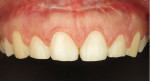 Postoperative close-up retracted photograph of the maxillary arch 6 months after surgery. Note the healing of the surgical scar, absence of frenal pull, and absence of marginal inflammation around the exposed clinical crowns.