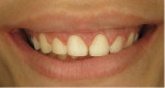 Postoperative smile photograph 6 months after surgery. Note the complete exposure of the clinical crowns to the cementoenamel junction, stability of the soft tissue, and significantly less gingival display when compared with the pretreatment smile photograph. When the patient is no longer undergoing passive eruption, further crown lengthening combined with osseous reduction and porcelain laminate veneers can provide her with an even more balanced outcome if she desires.