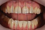 Pretreatment retracted view demonstrating that the teeth have divergent axial inclinations and that the central incisors have an unfavorable width-to-height ratio of 96%.
