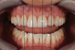 Posttreatment retracted view demonstrating that the axial inclinations were corrected and that the teeth now exhibit a much more favorable width-to-height ratio of 83%.