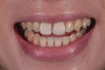 Pretreatment smile photograph of a patient who previously underwent an esthetically unsuccessful attempt at midline diastema closure. Note how tooth No. 8 is shorter than tooth No. 9 and the treatment of undersized tooth No. 10.