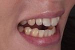 Pretreatment right lateral view with the teeth apart demonstrating flaring of the maxillary anterior teeth.