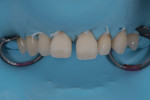 Removal of the existing restorations under rubber dam isolation (Isodam®, Sigma Dental Systems) revealed the true size of the midline diastema, the difference in length of the central incisors, and the nature of undersized tooth No. 10. Prior to applying the dam, small amounts of flowable composite (inspiro®, Edelweiss DR) were placed at the cervical aspects of the teeth to create a convexity for the placement of floss ligatures.