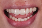 Posttreatment smile photograph demonstrating that the diastema is now fully closed and that the teeth exhibit correct proportions.