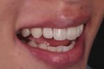 Posttreatment right lateral smile photograph. By adding volume to the middle and cervical parts of the facial aspects of the teeth, the flared appearance was improved.