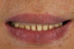 Pretreatment smile photograph of a patient who previously underwent midline diastema closure demonstrating a guarded smile with no reveal of the maxillary incisors.