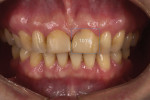 Pretreatment retracted view demonstrating that the existing restorations are failing and that the maxillary central incisors appear extremely “squat” with width-to-height ratios of approximately 101%.