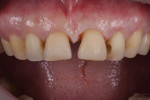 Retracted close-up view of the maxillary arch after the previous restorations were removed revealing a very large midline diastema as well as smaller diastemas distal to the central incisors.