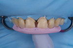 A rubber dam (Isodam®, Sigma Dental Systems) was secured over the cervical outlines, and a lingual stent (Lab-Putty, Coltene) based on the diagnostic wax-up was placed to layer the lingual shelves of the restorations.