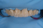 After the application of a dentin layer and the development of the interproximal areas, flowable composite (inspiro®, Edelweiss DR) was used in a layering process to complete the restorations.