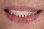 Postoperative smile photograph of the final direct composite veneers. Note that the patient’s smile is less guarded and appropriately displays the maxillary incisors.