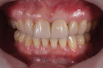 Posttreatment retracted view demonstrating that the central incisors now exhibit an acceptable width-to-height ratio of 90%.