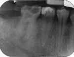 Fig 1. Preoperative intraoral radiograph of carious mandibular molar (tooth No. 30).