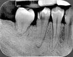 Fig 2. Intraoral radiograph of autotransplanted tooth at 6-month follow-up.