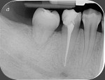 Fig 3. Intraoral radiograph of autotransplanted tooth at 24-month follow-up.