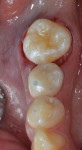 Fig 6. Donor tooth (No. 1) transplanted to the recipient socket No. 30.