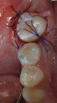 Fig 7. Autotransplanted tooth stabilized in the socket with stitches.