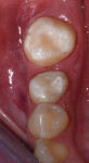 Fig 8. Autotransplanted tooth at 24-month follow-up.