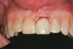 Figure 1  Preoperative intraoral frontal photograph of tooth No. 9.