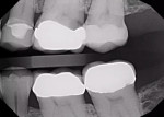 Fig 2. Preoperative radiograph showing tooth No. 14 with distal failure.